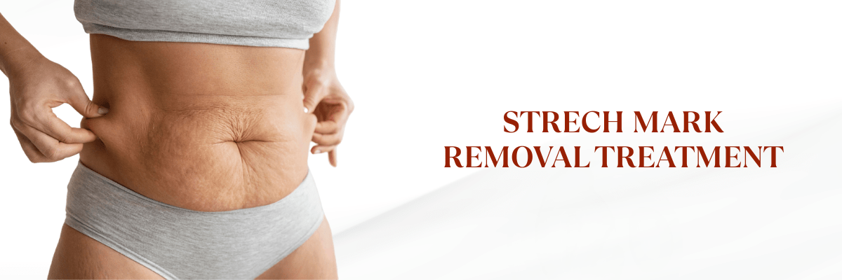 Stretch Mark treatment in Hyderabad