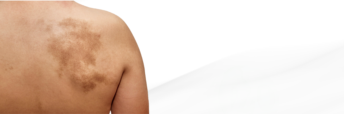 birth mark treatment in Hyderabad