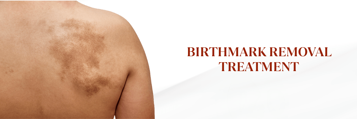 birth mark removal treatment in Hyderabad