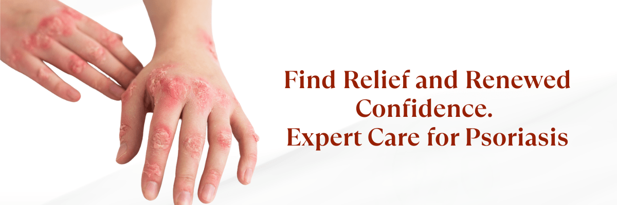 psoriasis treatment in Hyderabad