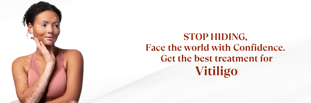 vitiligo treatment in Hyderabad