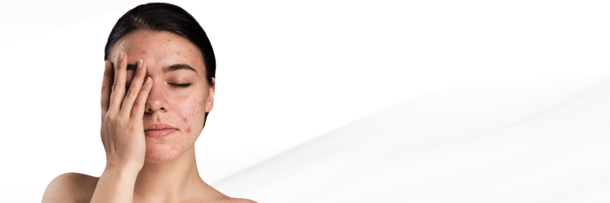 pimple-treatment in Hyderabad 