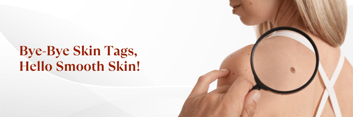 skin tags removal treatment in Hyderabad 