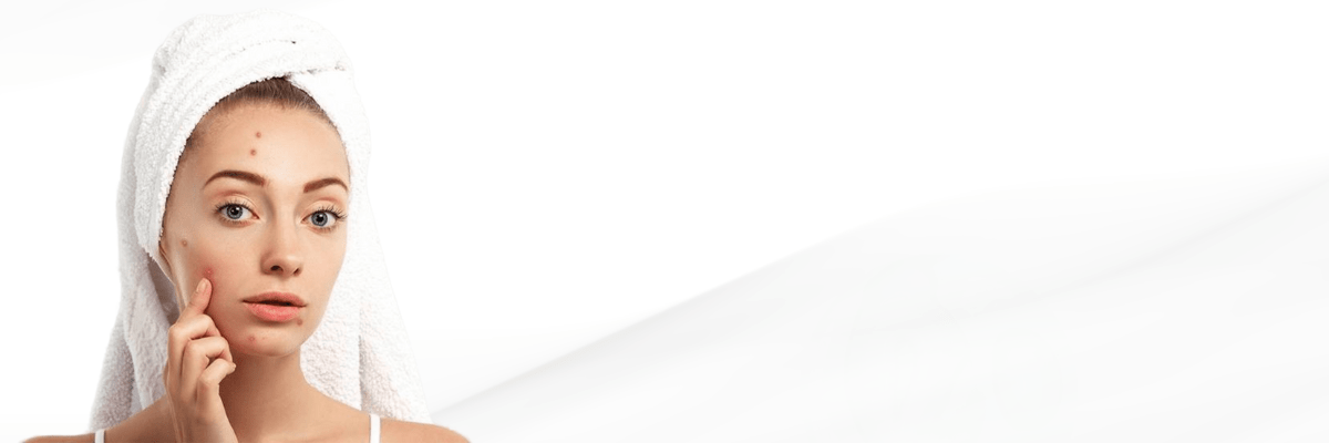 Acne scar treatment in Hyderabad