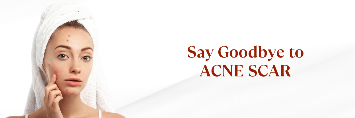 Acne scar treatment in Hyderabad